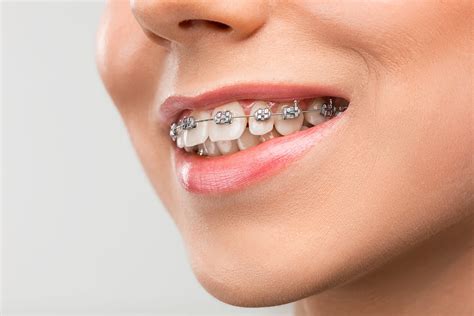 invisalign  braces