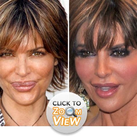 Lisa Rinna Lips Before And After Lisa Rinna Denies Getting More