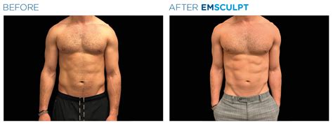 muscle building toning definition treatment   gain muscle tone