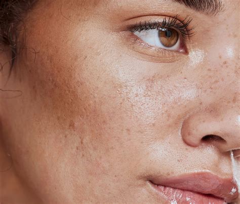 ALMA iPixel Laser | Cosmetic Clinic | Isle of Man