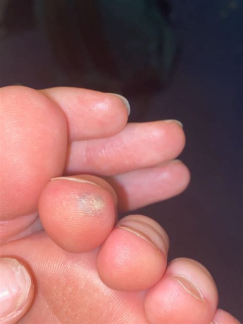 what is this spot on my toe? do i need to be worried : r