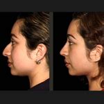 Dramatic Rhinoplasty Results in Los Angeles, California - The Plastic Surgery Channel