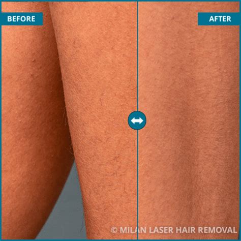 Laser Hair Removal Before And After - Philips Lumea Experts
