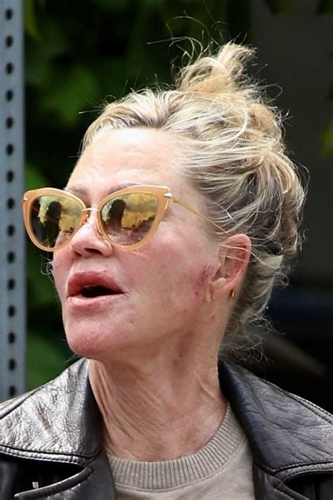 Melanie Griffith seen with apparent bruises on hand, face
