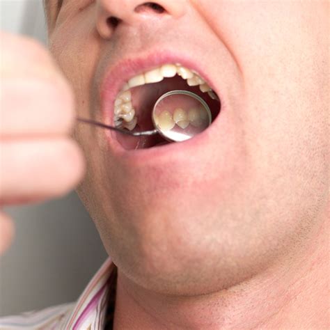 Wisdom Teeth Removal Gone Wrong