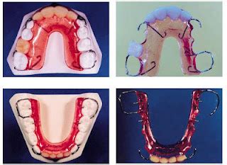 Odontosabara: Mantenedor de espaço