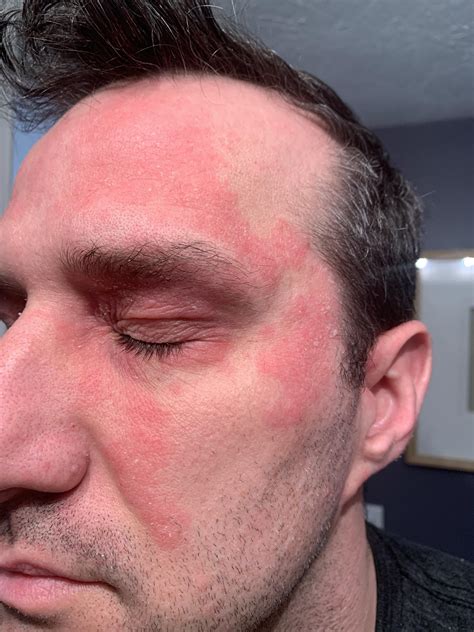 phentermine rash pictures 8