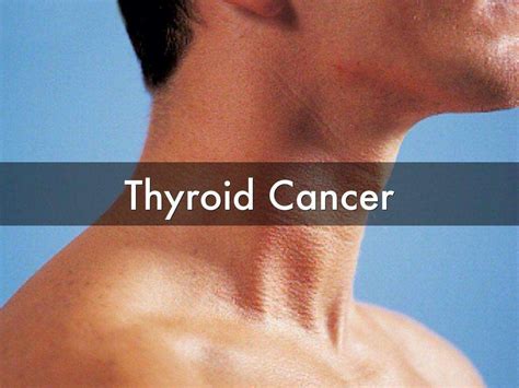 Thyroid Cancer: What Is Thyroid Cancer?