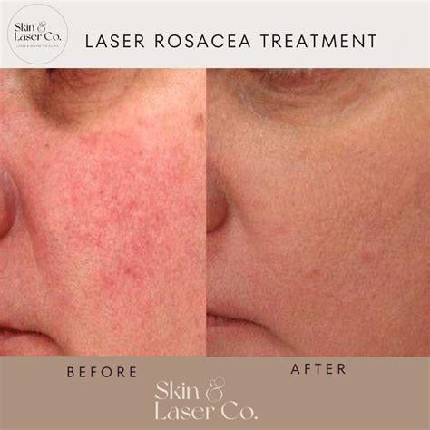 Laser Treatment for Rosacea - Skin Laser Co