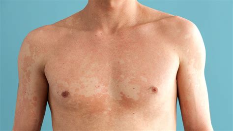Tinea Versicolor Before And After