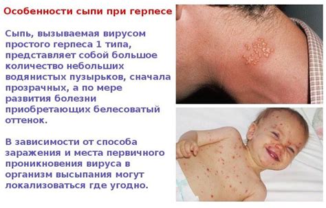 Особенности сыпи при герпесе на теле, фото | Тело, Мужчины, Женщина