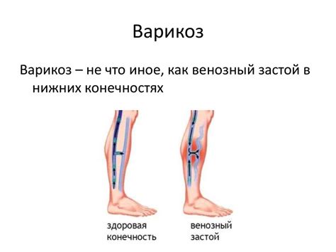 Венозная гиперемия. Причины и механизмы развития. Признаки и ...
