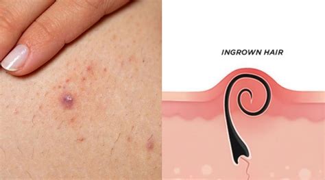 ingrown hair  thigh   prevent ingrown hairs philips