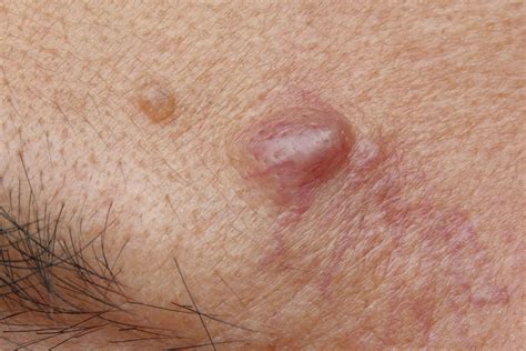 pimple on head under hair 4