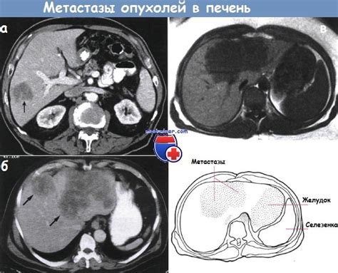 Симптомы метастазов печени и их диагностика