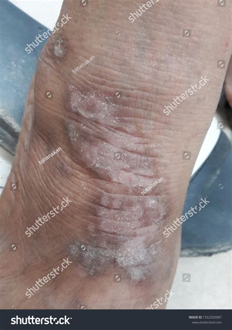 Dermatitis Fungal Infection On Body Stock Photo 1552550987 | Shutterstock