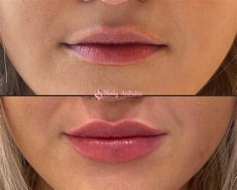 Lip Filler Injections - Benefits, Costs, Results & Procedure Steps