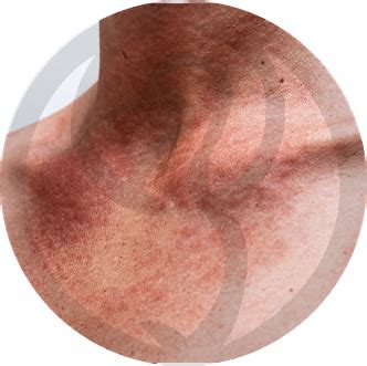 O Que É Fotossensibilidade - Fotossensibilidade - Clinica Derma Lineexplica o que é