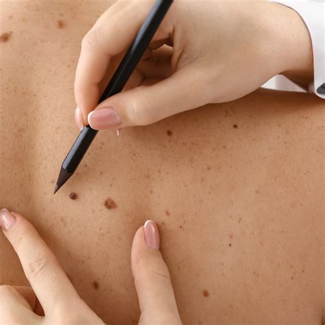 Melanoma vs. Other Skin Cancers: What’s the Difference?