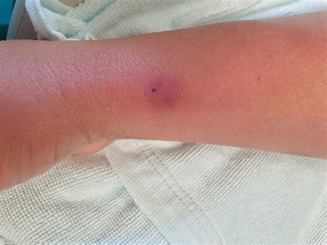 Phlebitis | Thrombophlebitis | Vein Condition | Vein Doctors Sydney