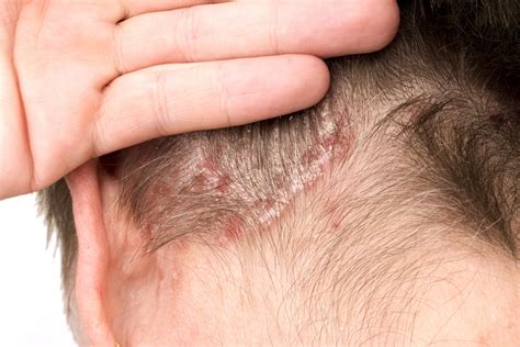 Scalp Psoriasis Treatment: Discover Effective Scalp Psoriasis ...