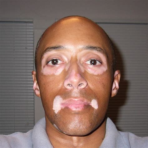 What is Vitiligo? - Daavlin