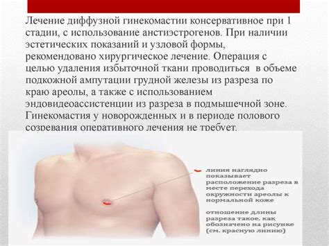 Гинекомастия. Виды истинной гинекомастии - презентация онлайн