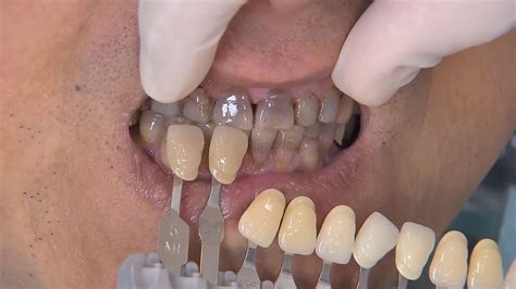 Tetracycline Teeth