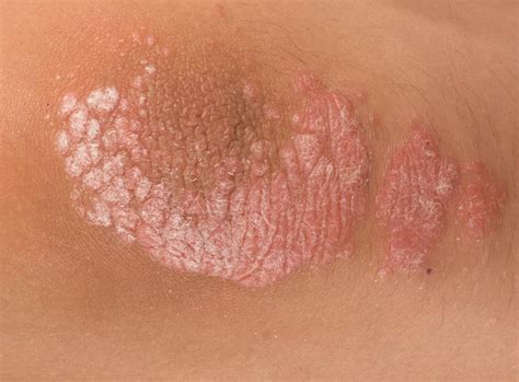mild psoriasis arms