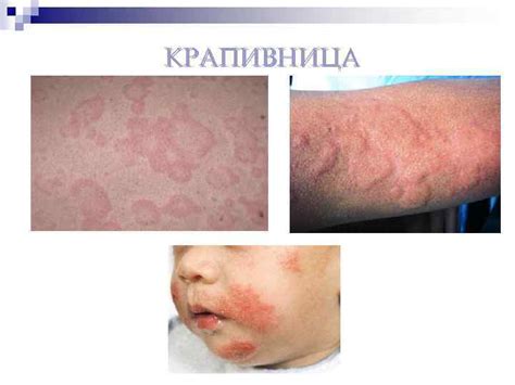 Атопический дерматит (АД) – заболевание кожи, которое наблюдается