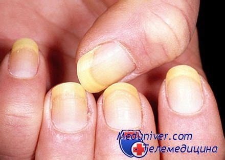 Как отбелить ногти в домашних условиях от желтизны? Причины и методики