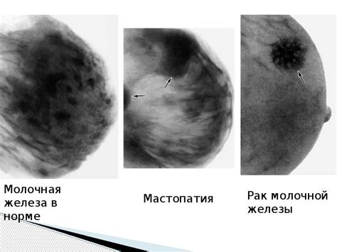 Рак Молочной Железы Развивается