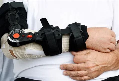 Broken Elbow: Recovery Time, Surgery, Treatment, Symptoms & Signs