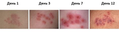 Опоясывающий лишай - причины, симптомы и лечение у взрослых
