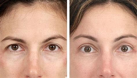 brow lift benefits    brow lift vrogueco