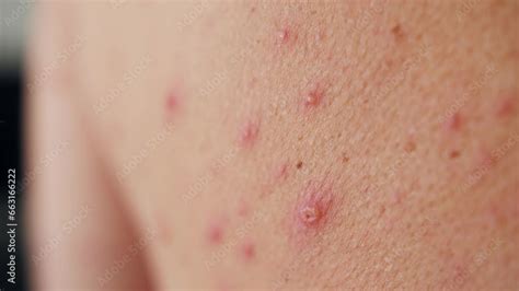 close   chicken pox      adult person  classic