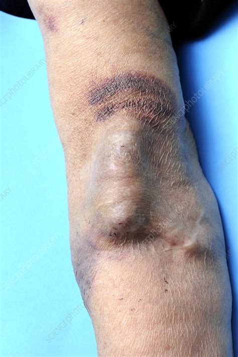 AV fistula in the arm for renal dialysis - Stock Image - C010/3238 ...