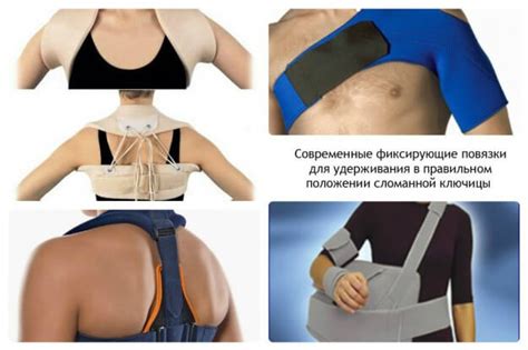 Перелом ключицы: лечение при переломе ключицы, операция, восстановление