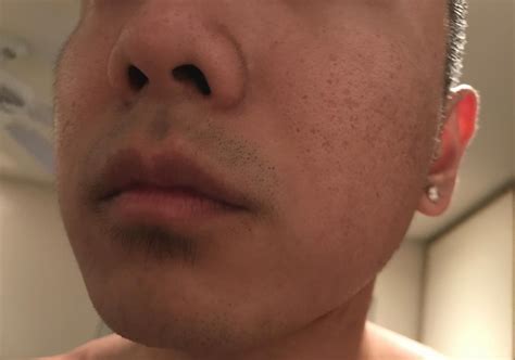 Deep Acne Scar treatments? – Scar treatments – Acne.org Forum
