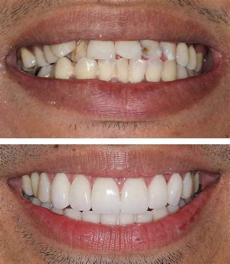 Porcelain Veneers or Braces? Make the Right Choice | Veneers teeth ...