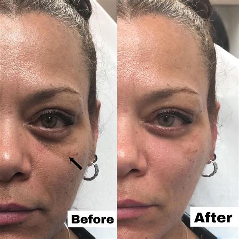 Belotero for Under Eye Bags - Temporary Smoothing and Wrinkle Filling