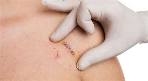 how long do you have to get stitches