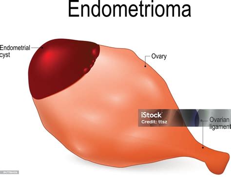 Endometrioma Ilustrasi Stok - Unduh Gambar Sekarang - Cokelat - Makanan ...