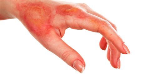TIPOS DE ACCIDENTES - primeros auxilios