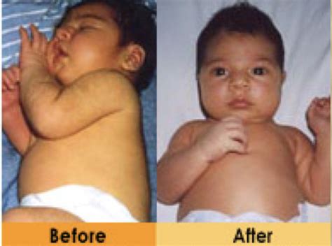 Peds: Newborn Common Disorders 2 (Exam 1) Flashcards | Quizlet 