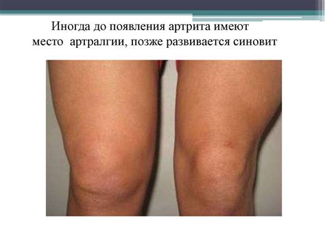 Клиника и диагностика ревматоидного артрита у детей - презентация онлайн