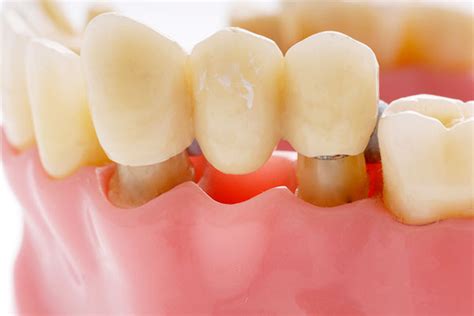 3-Types-1-Traditional-bridges – Asian Sun Dental Clinic Manila