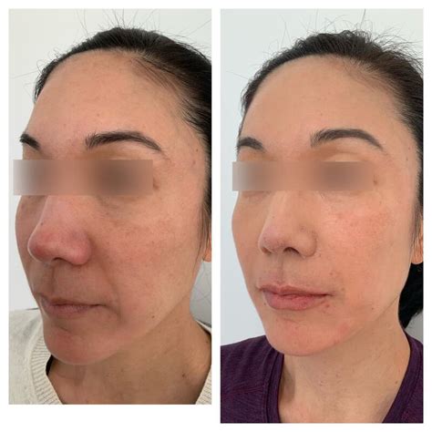 Before & After Dermal Fillers in Oakland | Refine Anti-Aging