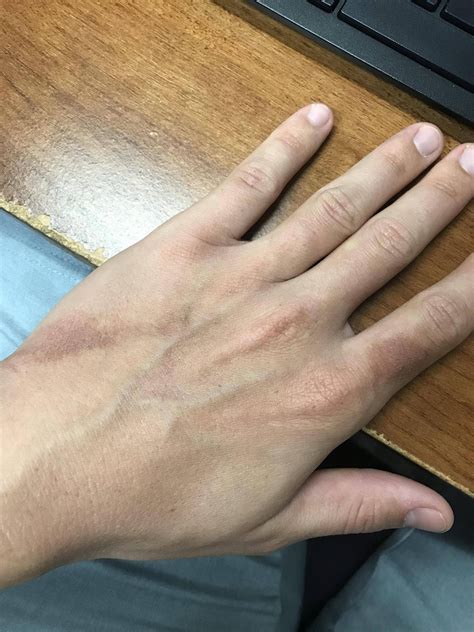 Discoloration on Hands. 5 days since I noticed it and only slight