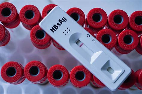 Mengenal Tes HBsAg untuk Mendeteksi Hepatitis B